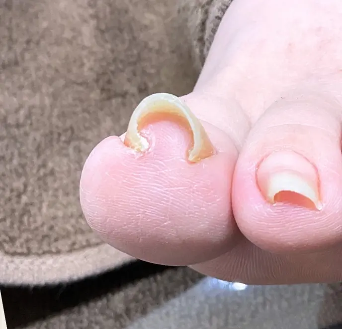 新宿巻き爪ケア ルポ症例写真 巻き爪補正Before