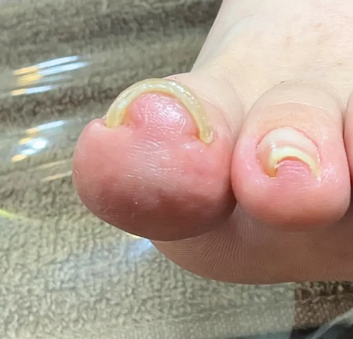 新宿巻き爪ケア ルポ症例写真 巻き爪補正After