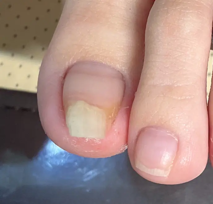 新宿巻き爪ケア ルポ症例写真 巻き爪補正Before