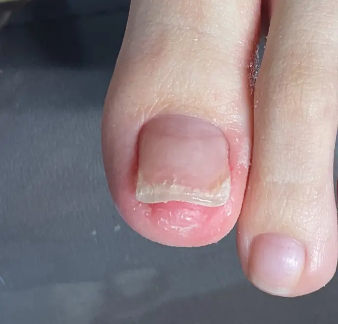 新宿巻き爪ケア ルポ症例写真 巻き爪補正After