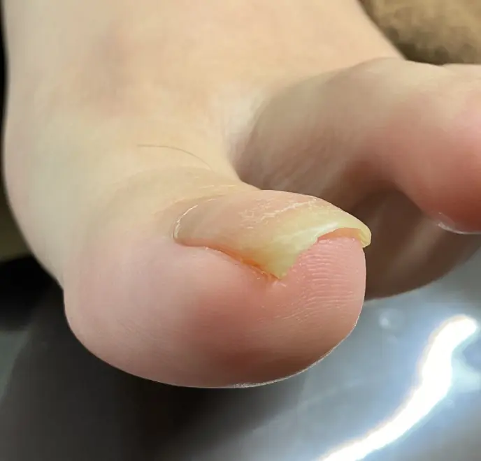 新宿巻き爪ケア ルポ症例写真 巻き爪補正Before