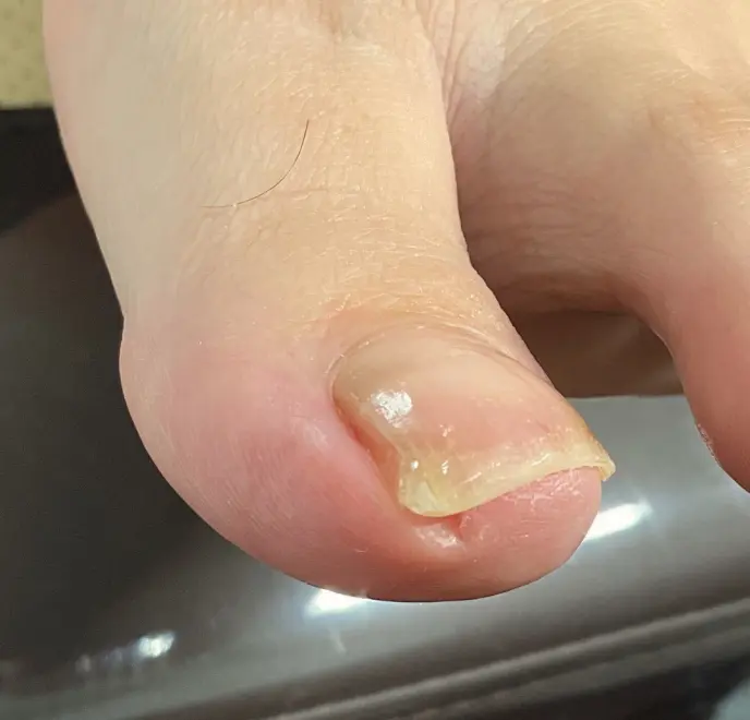 新宿巻き爪ケア ルポ症例写真 巻き爪補正After