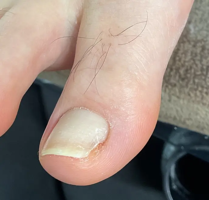 新宿巻き爪ケア ルポ症例写真 陥入爪補正Before