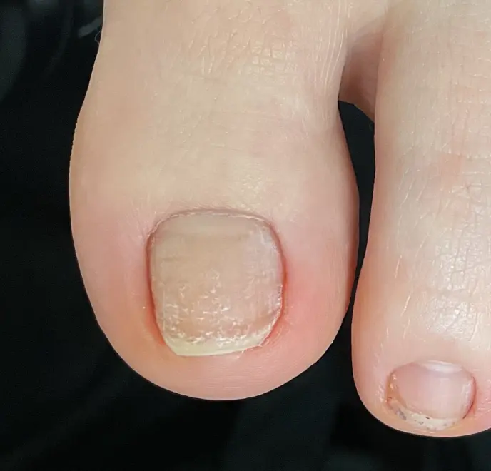 新宿巻き爪ケア ルポ症例写真 陥入爪補正Before
