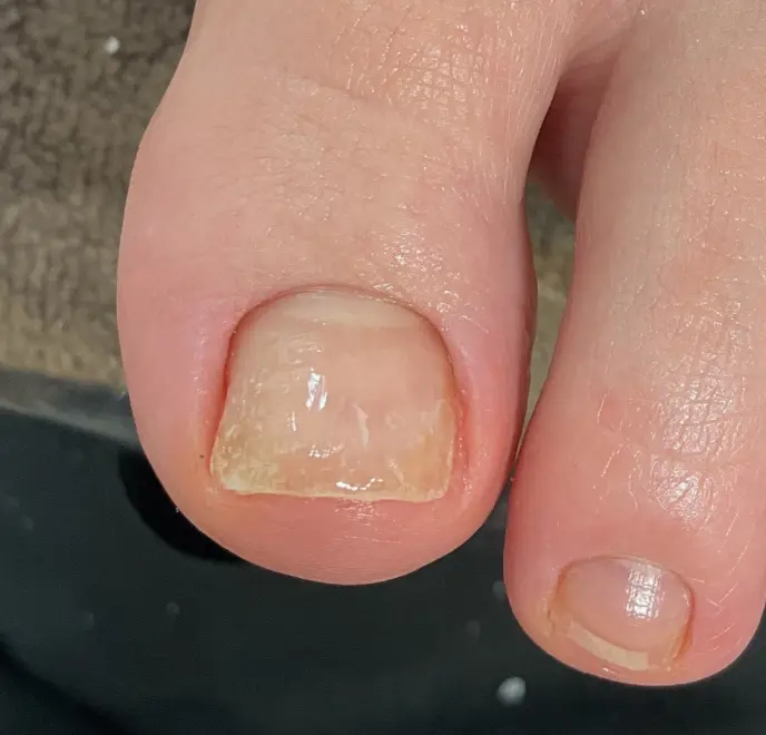 新宿巻き爪ケア ルポ症例写真 陥入爪補正After