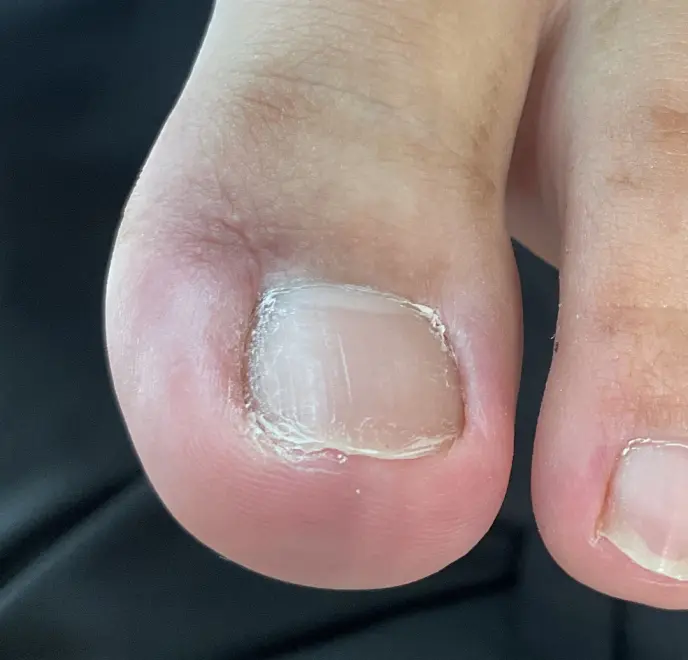 新宿巻き爪ケア ルポ症例写真 陥入爪補正Before