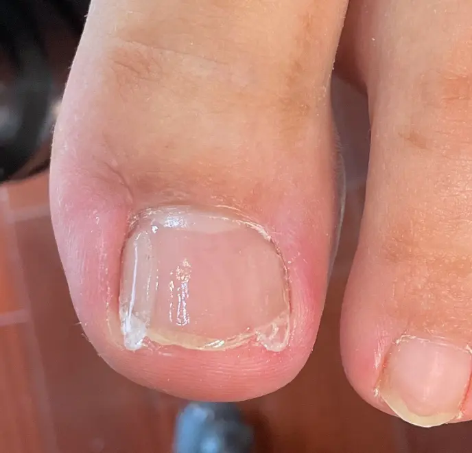 新宿巻き爪ケア ルポ症例写真 陥入爪補正After