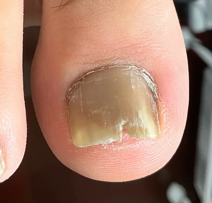 新宿巻き爪ケア ルポ症例写真 割れ爪・欠け爪Before