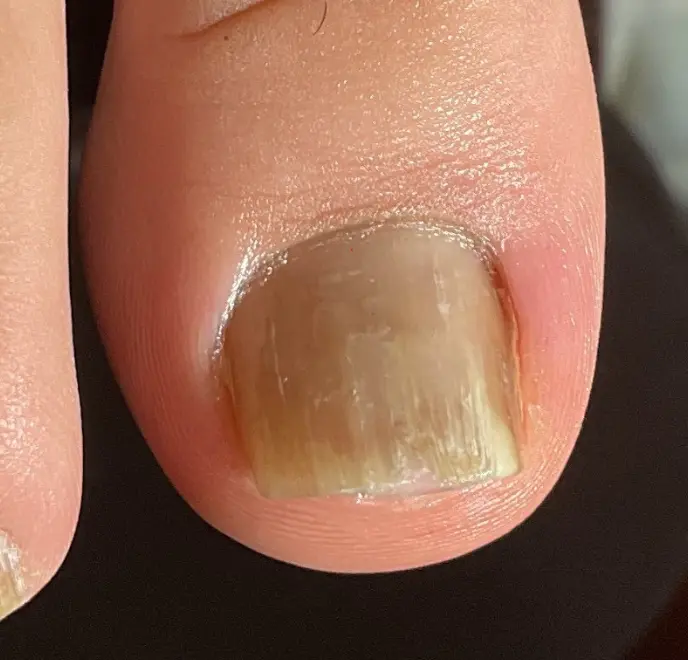 新宿巻き爪ケア ルポ症例写真 割れ爪・欠け爪After