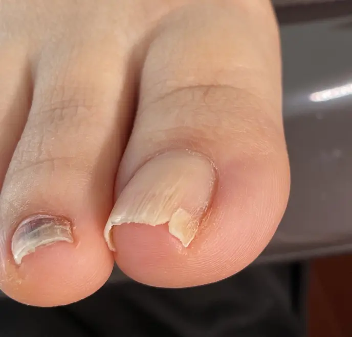 新宿巻き爪ケア ルポ症例写真 割れ爪・欠け爪Before