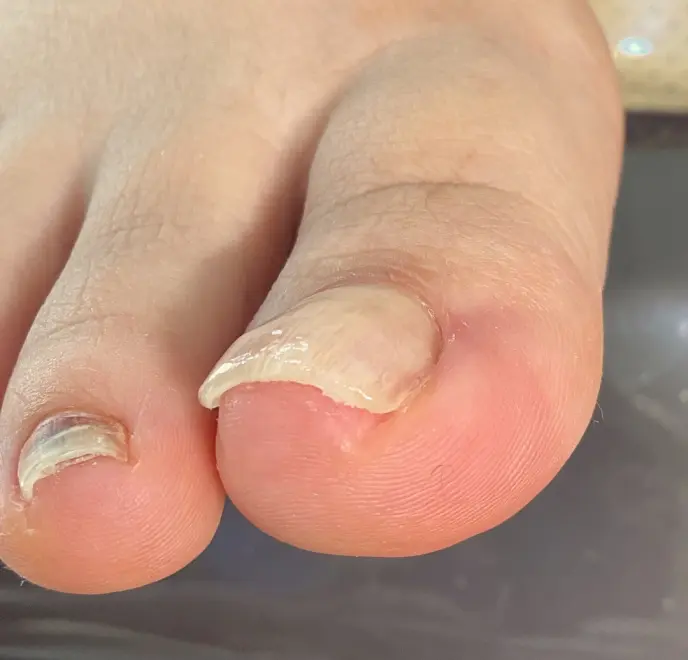 新宿巻き爪ケア ルポ症例写真 割れ爪・欠け爪After