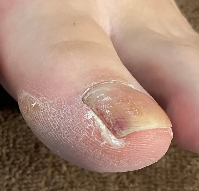 新宿巻き爪ケア ルポ症例写真 タコ・角質ケアBefore