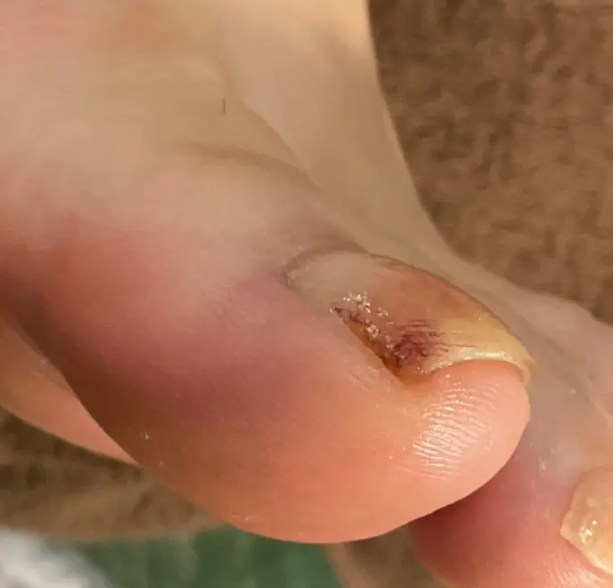 新宿巻き爪ケア ルポ症例写真 タコ・角質ケアAfter