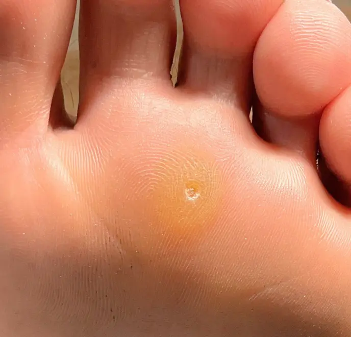 新宿巻き爪ケア ルポ症例写真 タコ・角質ケアBefore