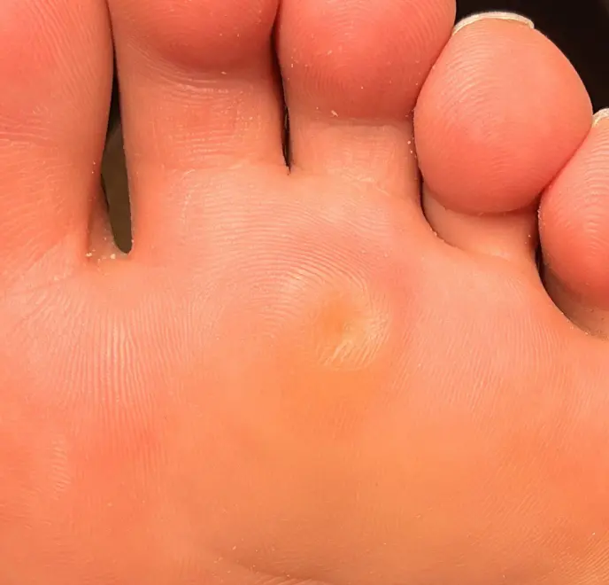 新宿巻き爪ケア ルポ症例写真 タコ・角質ケアAfter