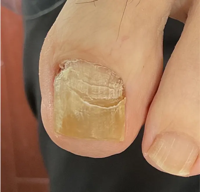 新宿巻き爪ケア ルポ症例写真 リストア・肥厚爪Before