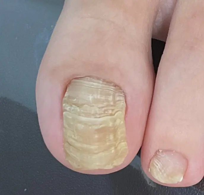 新宿巻き爪ケア ルポ症例写真 リストア・肥厚爪Before