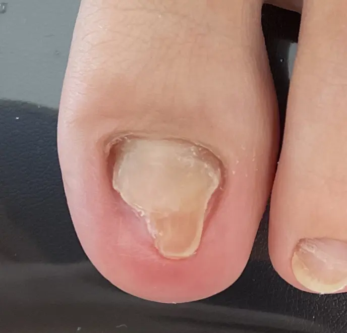 新宿巻き爪ケア ルポ症例写真 リストア・肥厚爪After