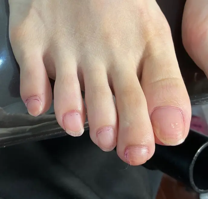 新宿巻き爪ケア ルポ症例写真 爪ケアBefore