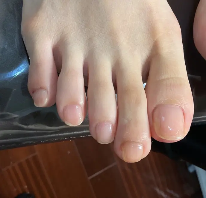新宿巻き爪ケア ルポ症例写真 爪ケアAfter